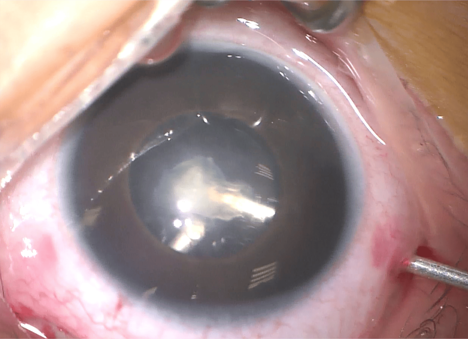 Joseph’s right lensectomy.