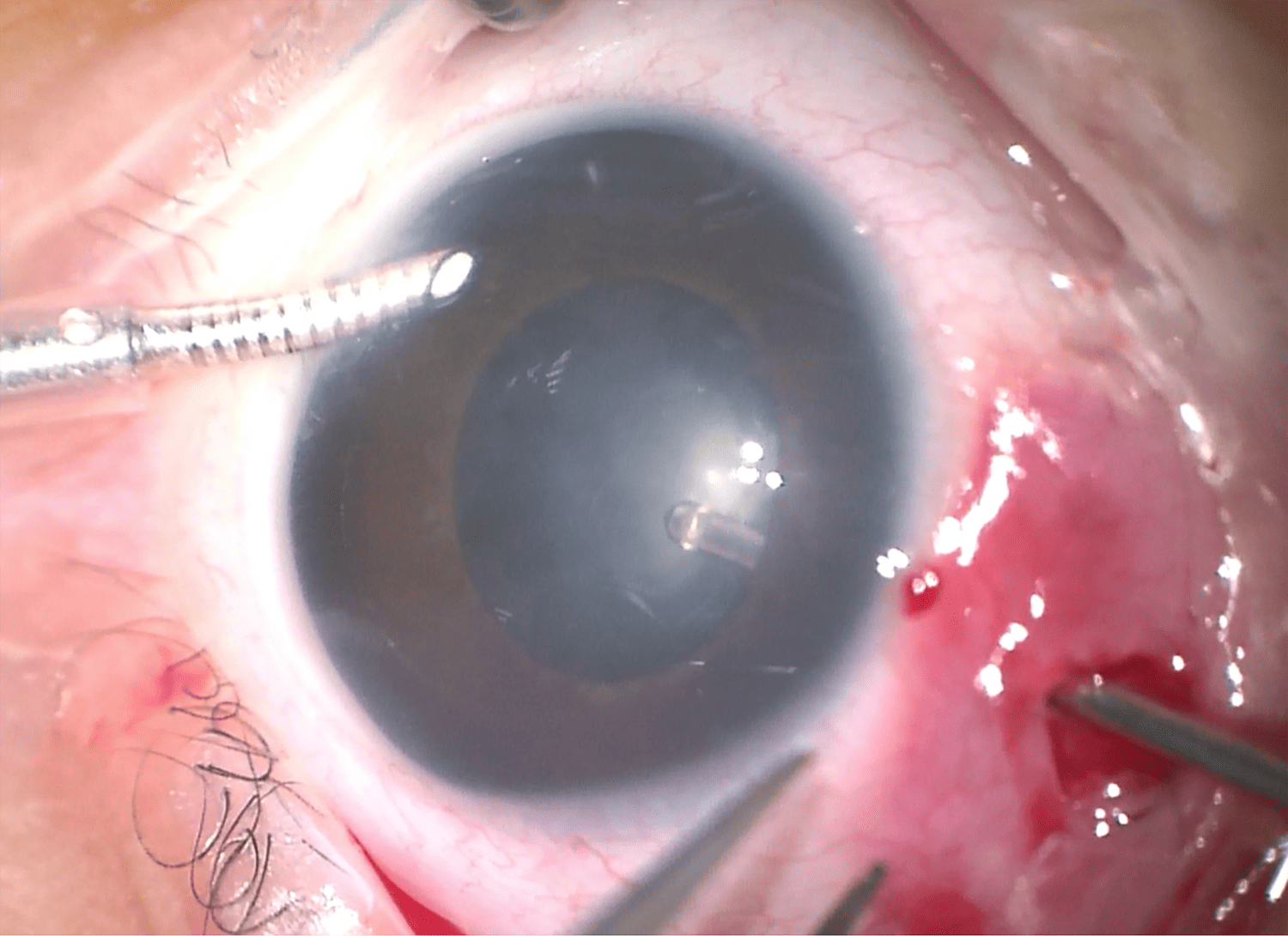 Figure 3. Joseph’s left lensectomy with an anterior chamber maintainer.