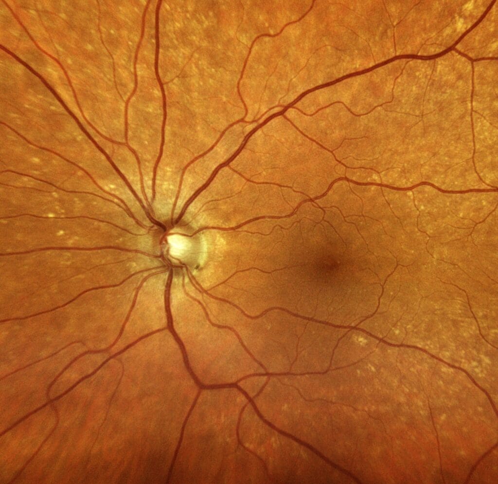 Left eye fundus