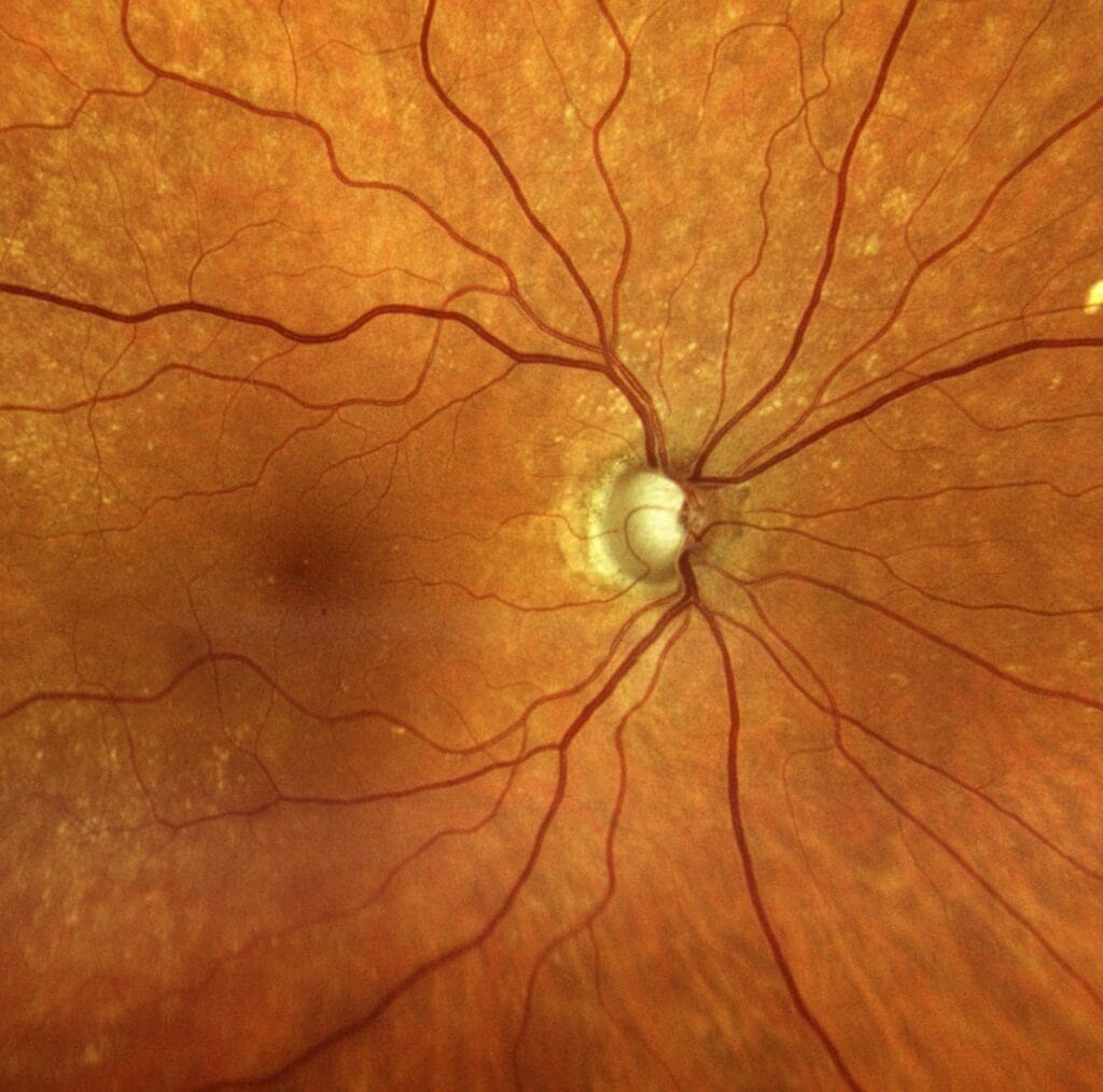 Right eye fundus