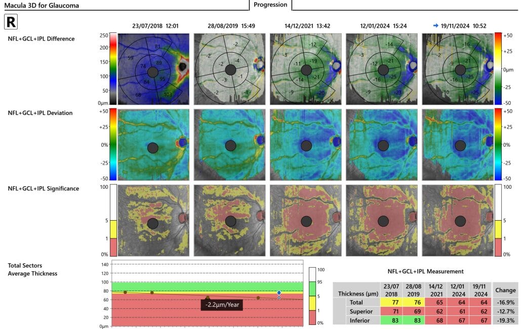 Figure 4. OCT showing right eye disease progression.