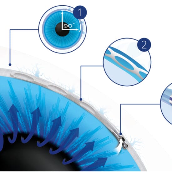 Hydrus Microstent