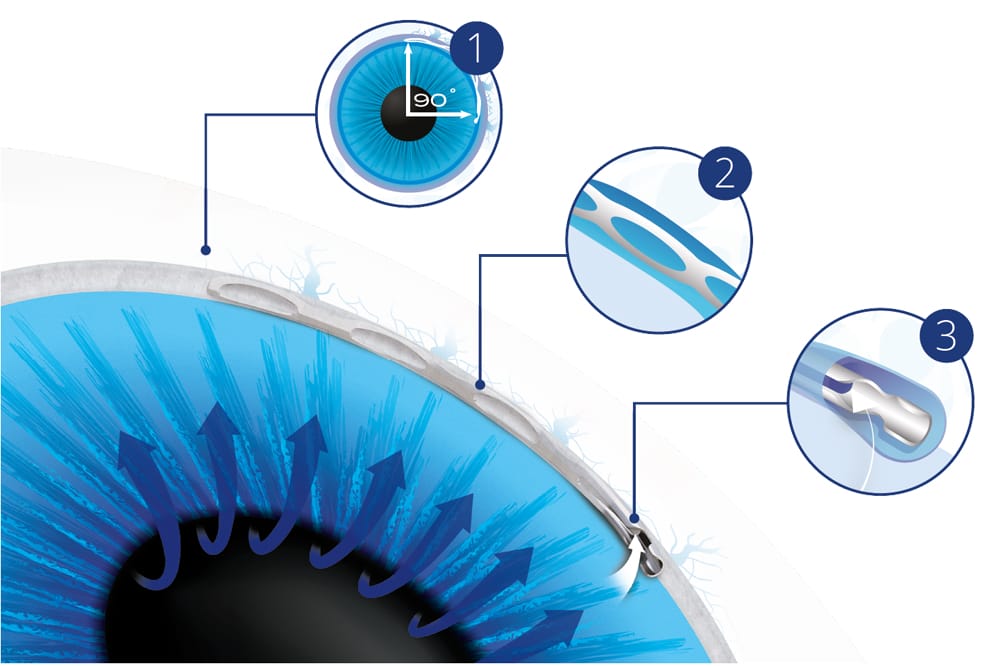 Hydrus Microstent