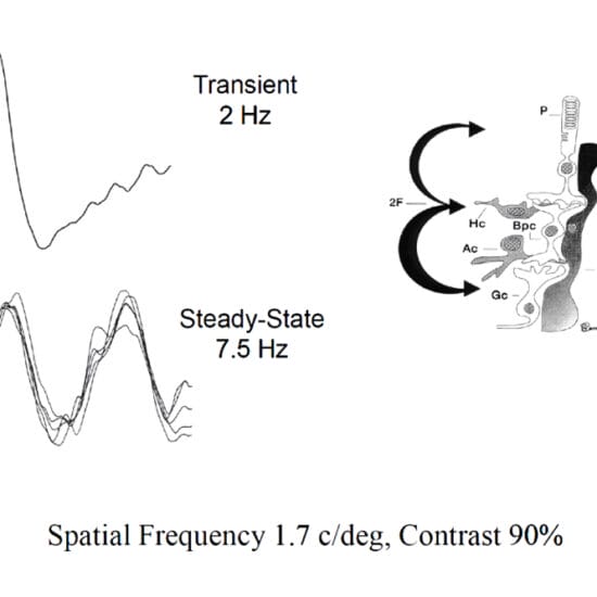 Figure 1. Pattern electroretinogram.