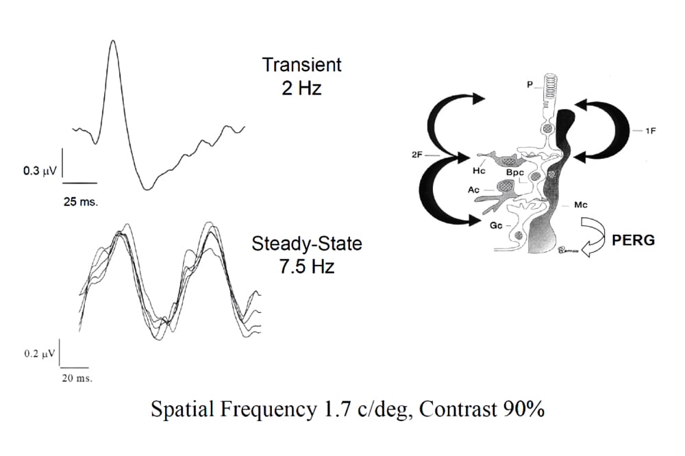 Figure 1. Pattern electroretinogram.
