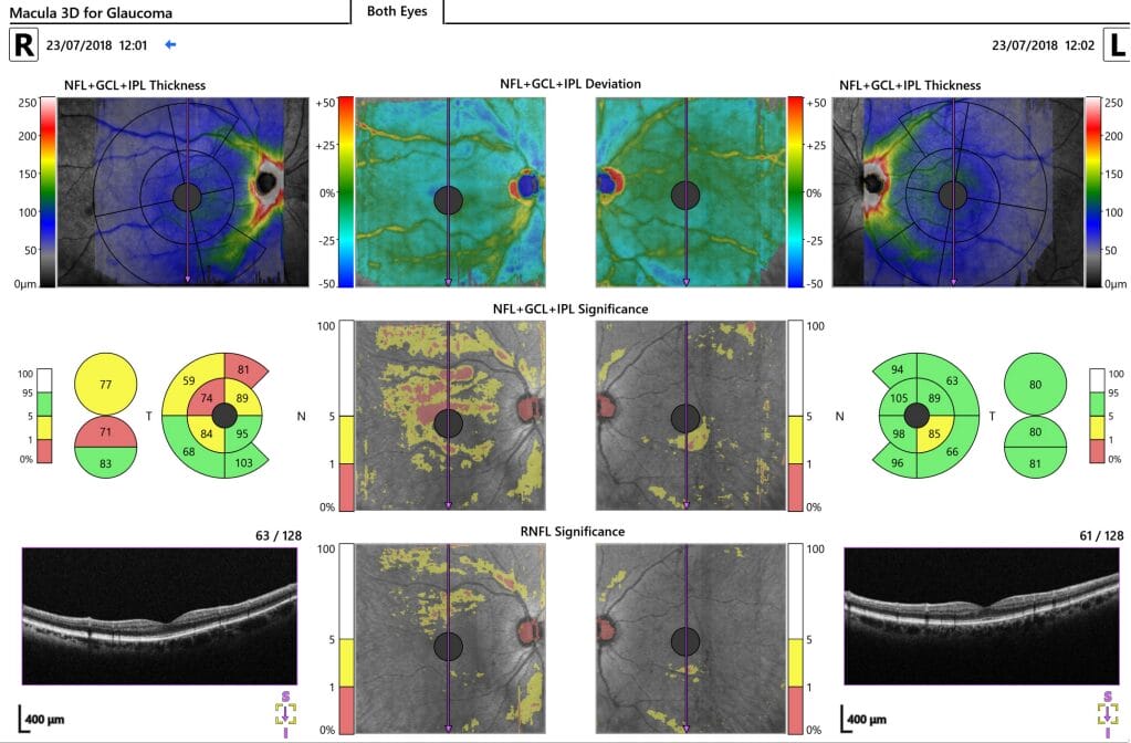 clinical diagnosis of glaucoma - Macula OCT used at presentation