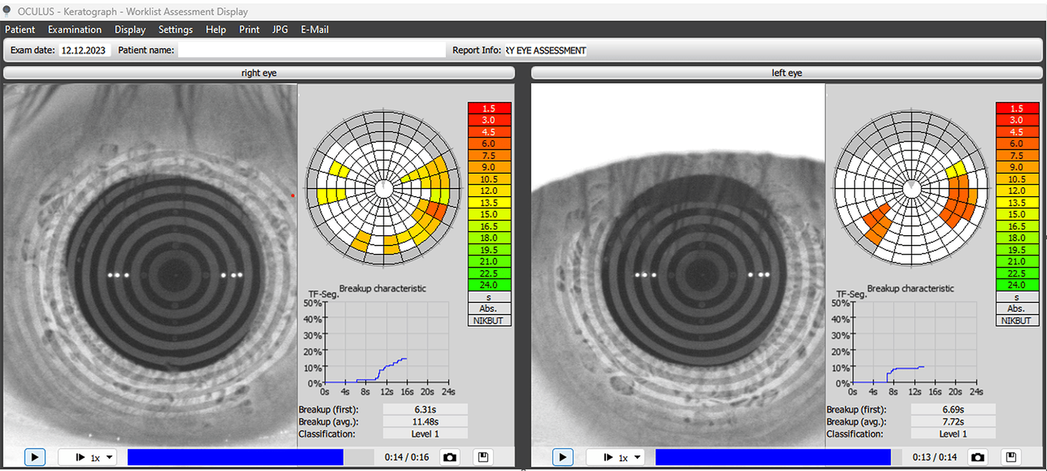Non-invasive keratograph tear break up time (NIKBUT) pre-Envision treatment for dry eye.