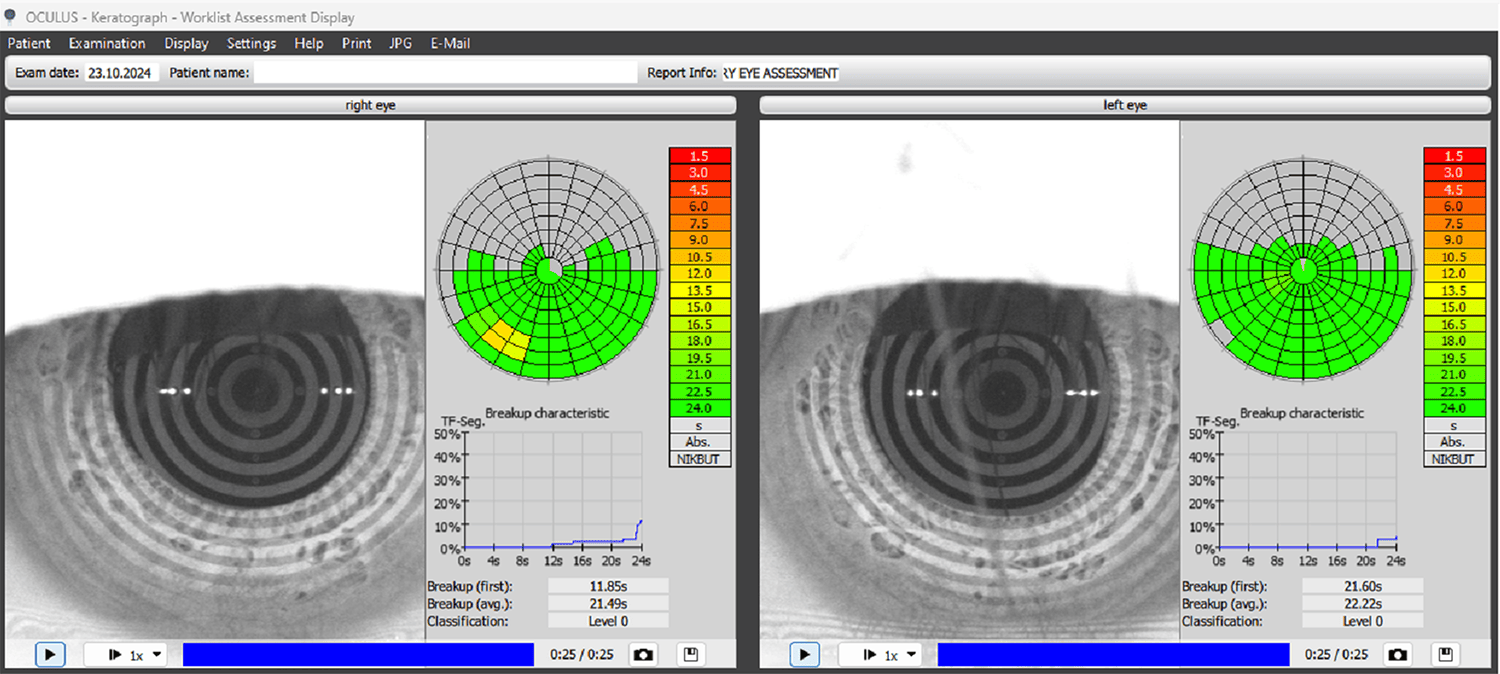 Figure 2. NIKBUT post-Envision treatment for dry eye