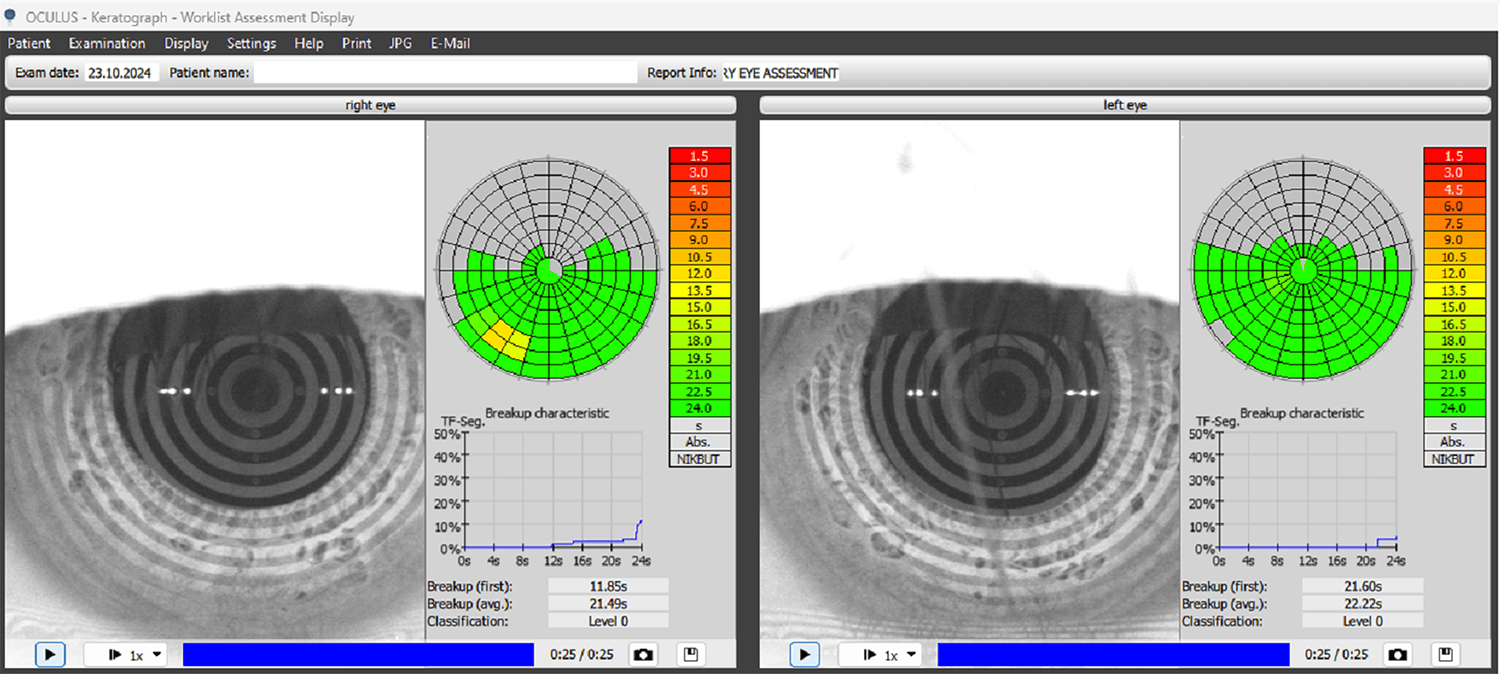 Figure 2. NIKBUT post-Envision treatment for dry eye