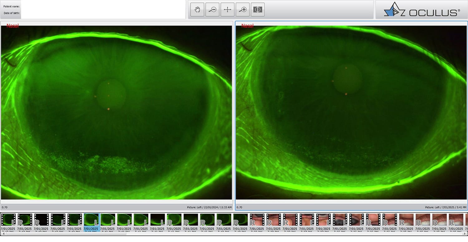 Figure 3. Corneal staining of left eye pre-Envision treatment (left) and post-Envision treatment (right) for dry eye