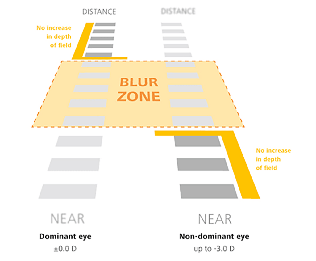 Figure 4. In monovision there is a ‘blur-zone’ where a patient will still require glasses to see because the depth of field is not enhanced to cover that specific area of vision.