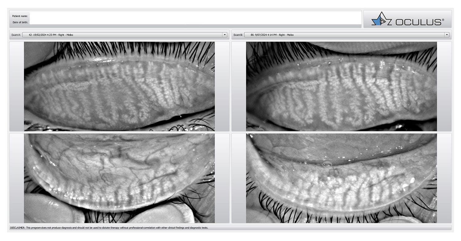 Figure 4. Improvement in meibography. The patient’s upper lid (top left) and lower lid (bottom left) before treatment. Images on the right show the same patient after Envision treatment for dry eye