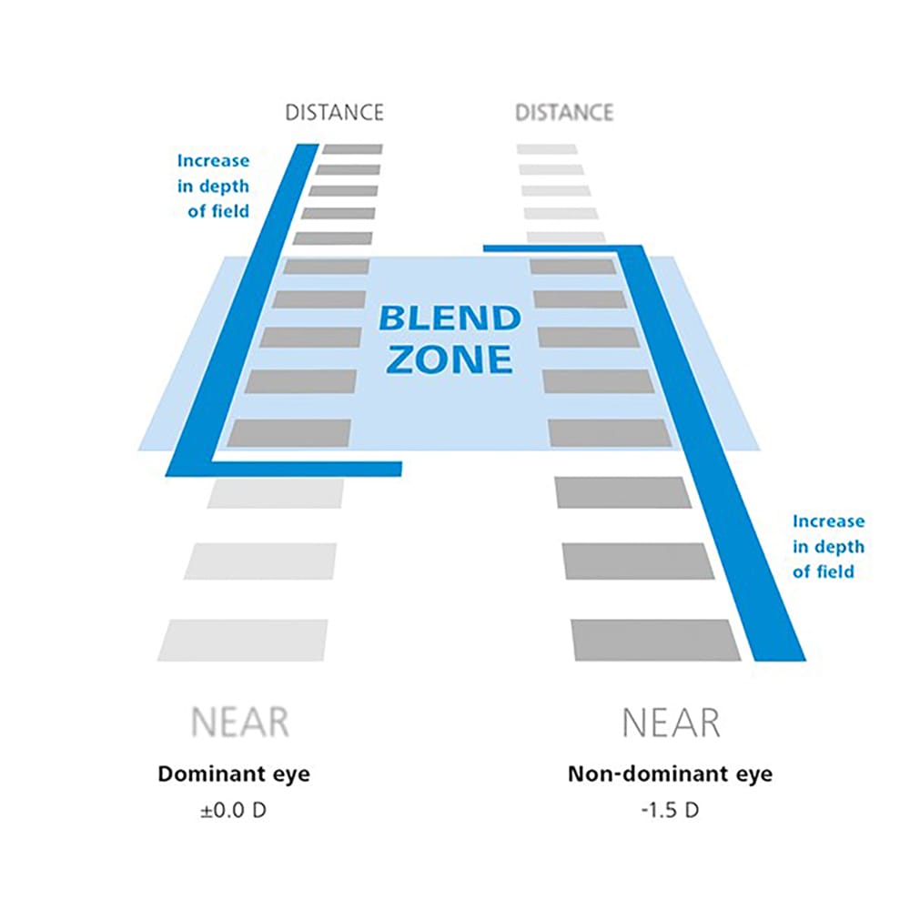 Figure 5. Anisometropia is induced in the non-dominant eye and there is an overlap of vision known as the ‘blend zone’.