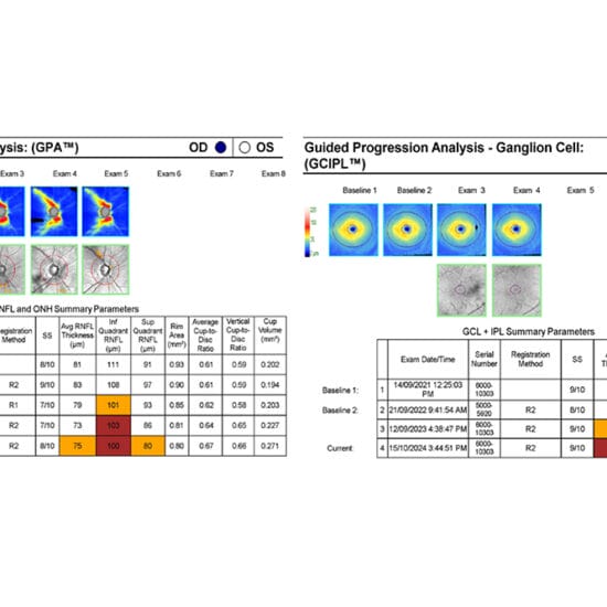 Figure 1. showing Guided progression analysis (RNFL and ganglion cell) of a C-Eye-C patient. Right eye results only are shown.