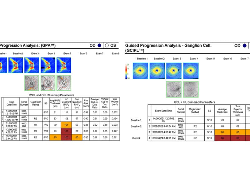 Figure 1. showing Guided progression analysis (RNFL and ganglion cell) of a C-Eye-C patient. Right eye results only are shown.