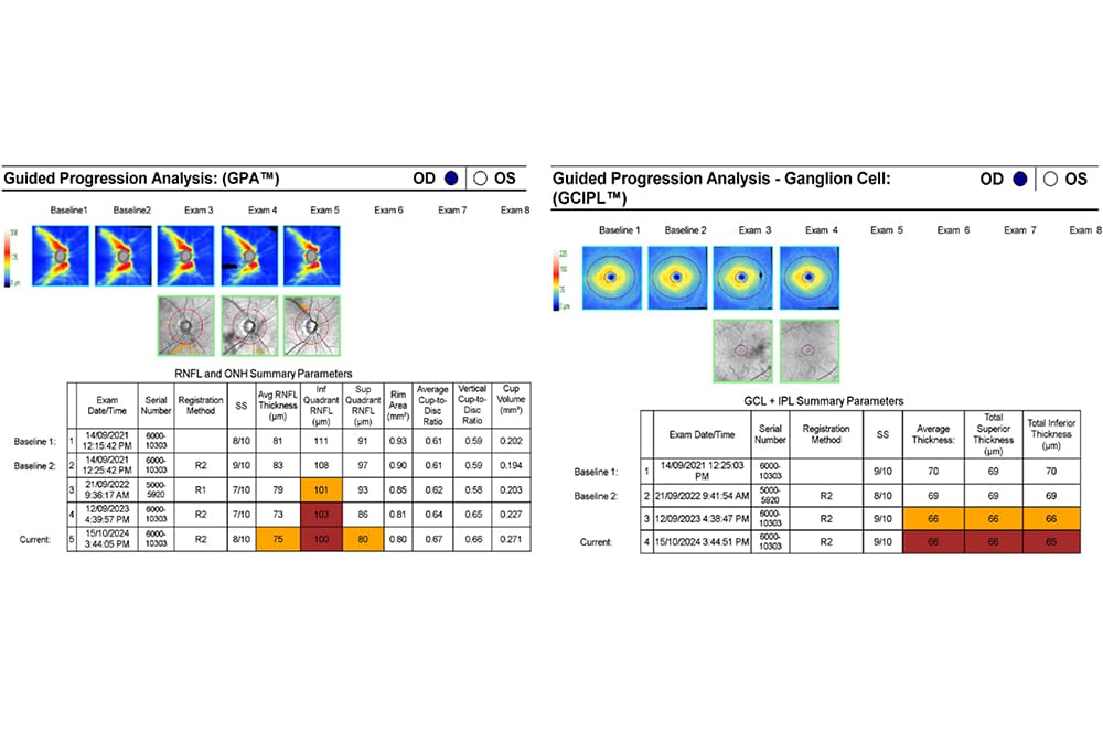 Figure 1. showing Guided progression analysis (RNFL and ganglion cell) of a C-Eye-C patient. Right eye results only are shown.