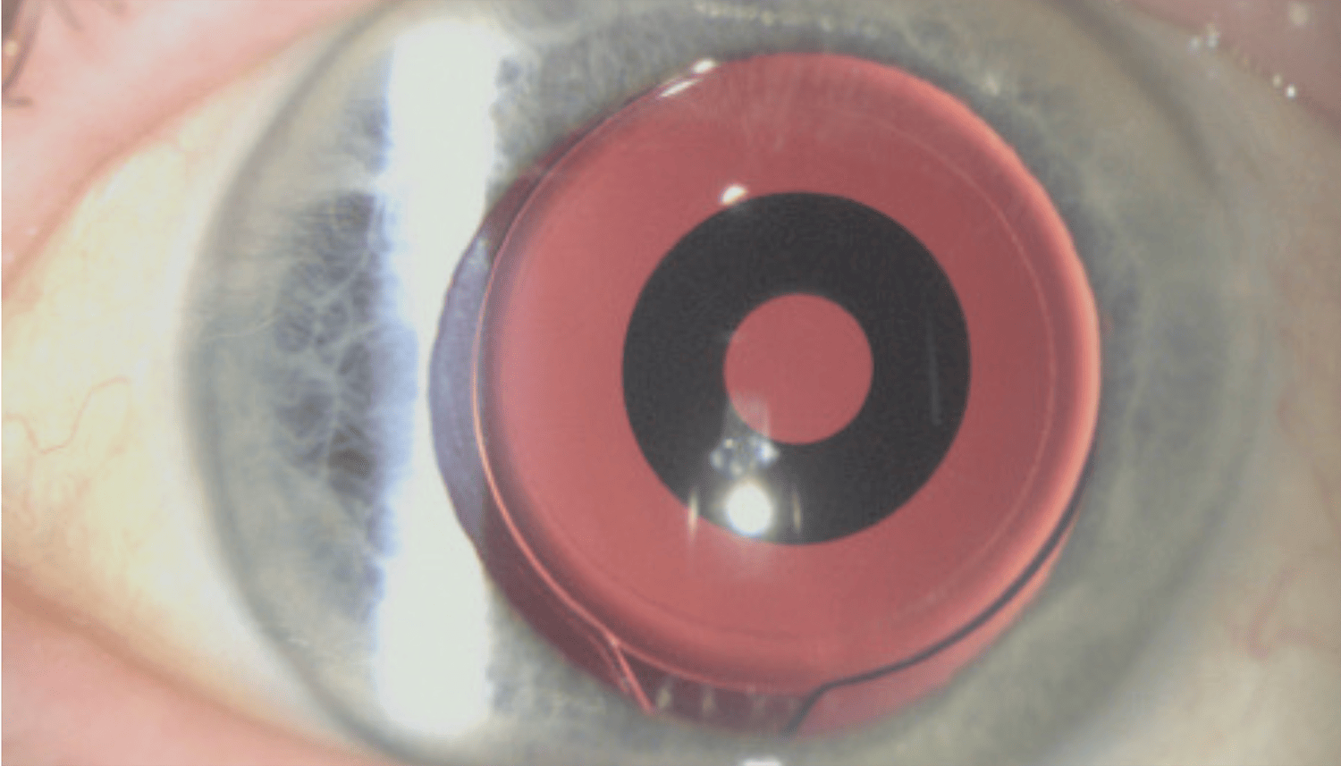 Figure 3. Example of a small aperture intraocular lens.
