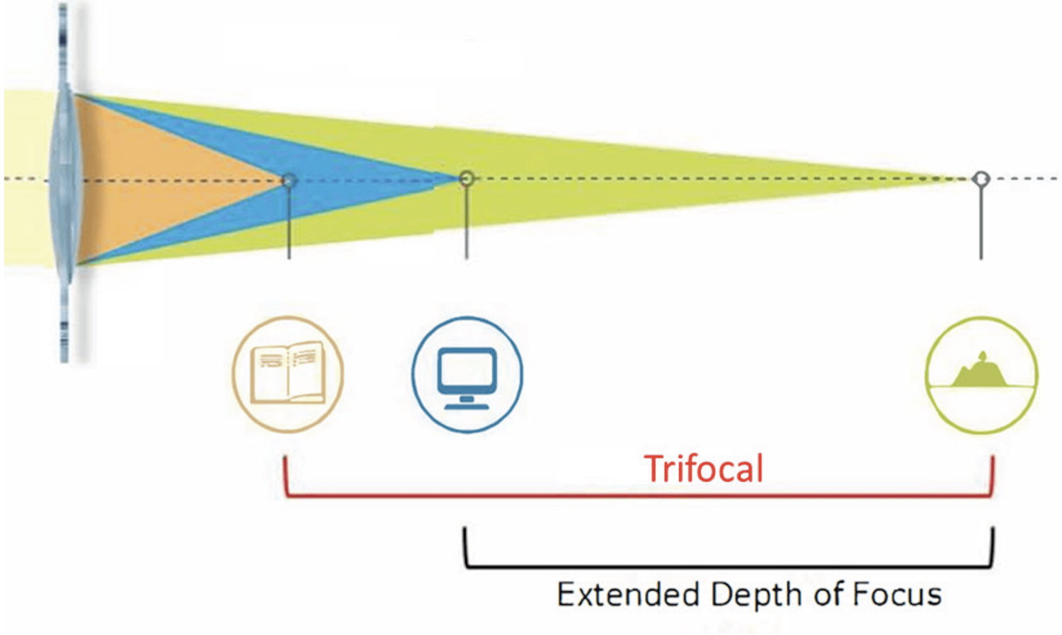 Figure 4. Trifocal intraocular lenses attempt to provide spectacle independence for distance, intermediate, and near tasks. Extended depth of focus (EDOF) intraocular lenses usually target distance and intermediate tasks with the requirement for glasses for reading fine print, particularly in dim lighting conditions. EDOF IOLs may well be better tolerated in patients with AMD.