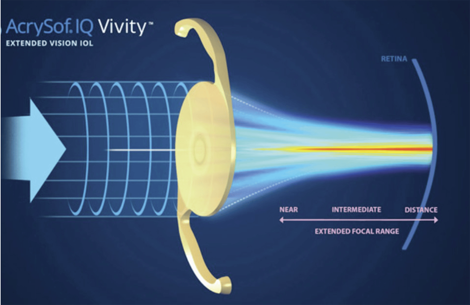 Figure 5: Principle of an extended depth of focus intraocular lens.