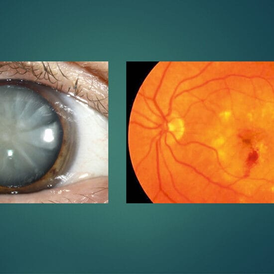 Cataracts and AMD