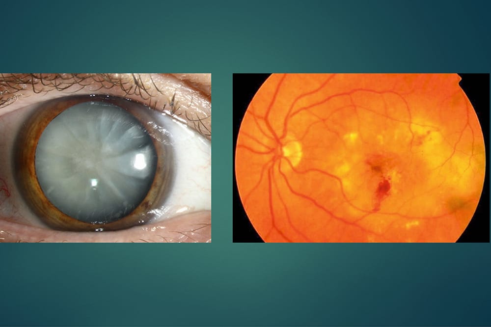Cataracts and AMD