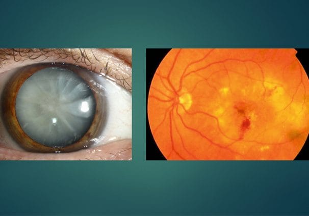 Cataracts and AMD
