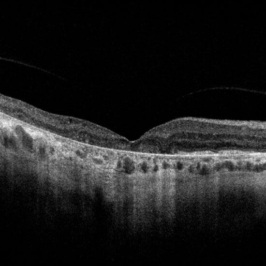 Figure 1. Multimodal imaging features of geographic atrophy.