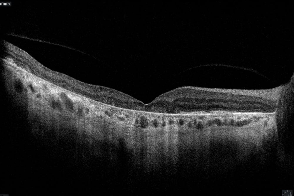 Figure 1. Multimodal imaging features of geographic atrophy.