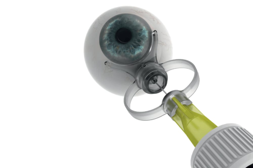 SP.Eye Intravitreal Device
