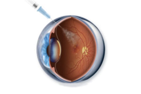 Cataract Surgery and AMD: What You Need to Know - mivision