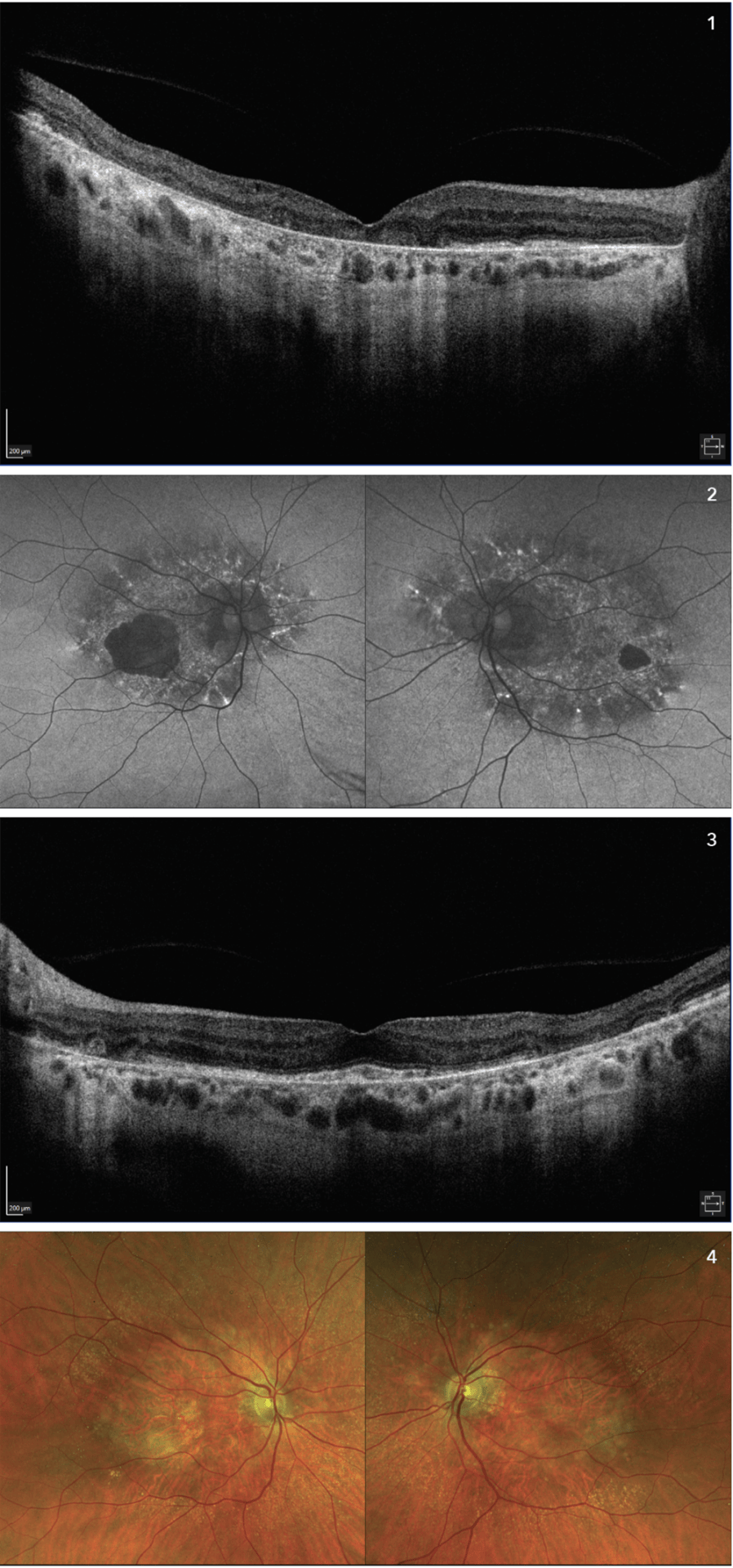 Figures 1–4. Multimodal imaging features of geographic atrophy. Right eye shows extensive GA with fovealinvolvement, left eye shows extrafoveal atrophy.