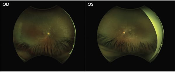 Figure 1. Patient with bilateral NPDR prior to laser treatment. A) right eye, B) left eye.