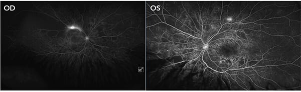 Figure 2. Fundus fluorescein angiogram of the same patient, showing areas of ischemia and neovascularisation.