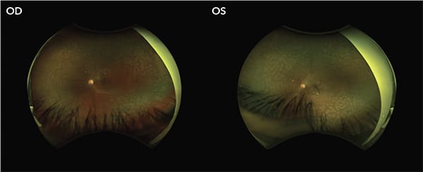 Figure 3. The same patient with bilateral NPDR following panretinal photocoagulation.