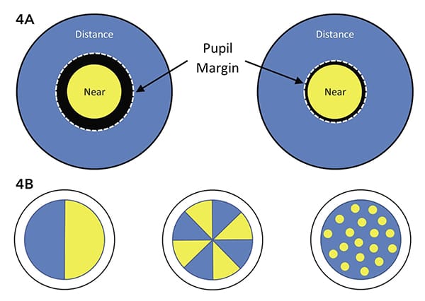 Figure 4. A) Effect of pupil size on distance: near ratio for a centre-near bifocal. Left: Large pupil allows roughly equal (50:50) amounts of light through distance and near portions. Right: Small pupil allows relatively little light (25:75) through the distance portion. B) Theoretically pupil-independent bifocal contact lens designs.