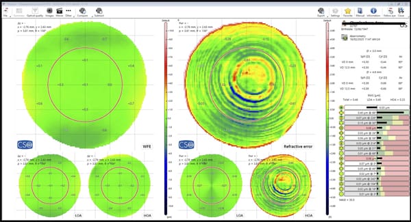 Figure 1. Aberrometry of an eye with a slightly decentred trifocal IOL. Diffractive rings are clearly visible.
