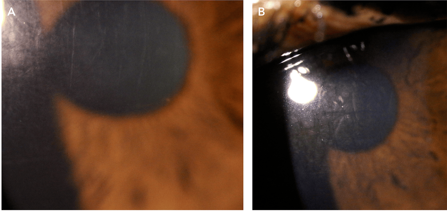Figure 1. Imaging showed moderate central corneal haze with prominent stromal striae A) right eye, B) left eye