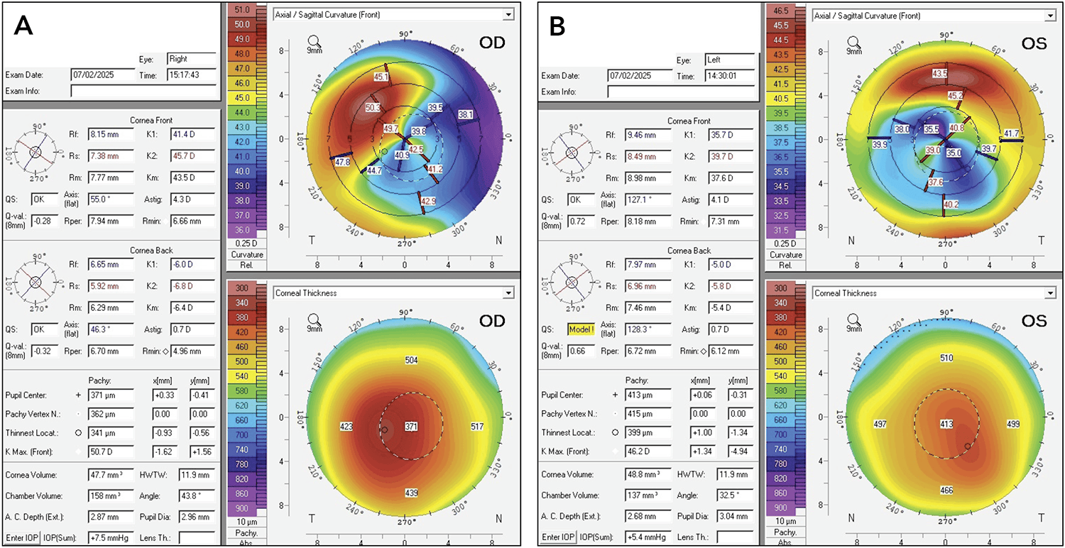 Figure 2. Tomography at presentation. A) right eye and B) left eye demonstrated inferior corneal flattening, appearing as the opposite of a cone typical of keratoconus.
