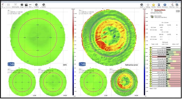 Figure 3. Aberrometry of an eye with a Rayner Galaxy IOL. The spiral optic pattern can be seen.