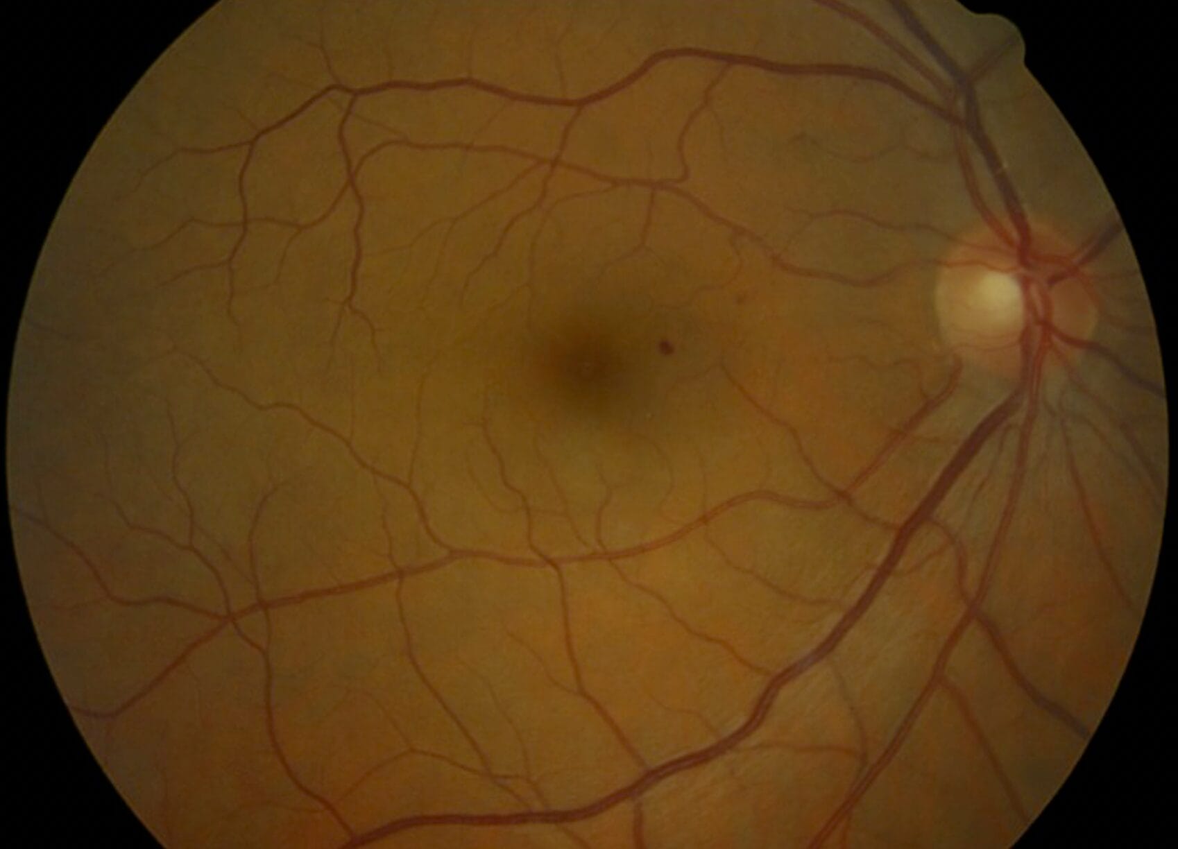 Figure 1. Mild NPDR with microaneurysm.