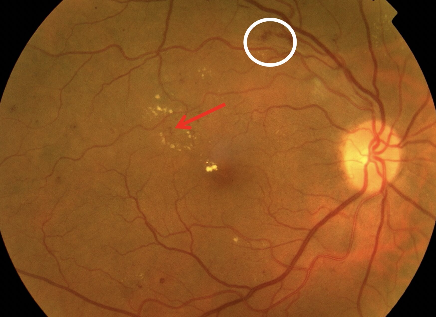 Figure 2. White circle: flame haemorrhage; red arrow: microaneurysm.