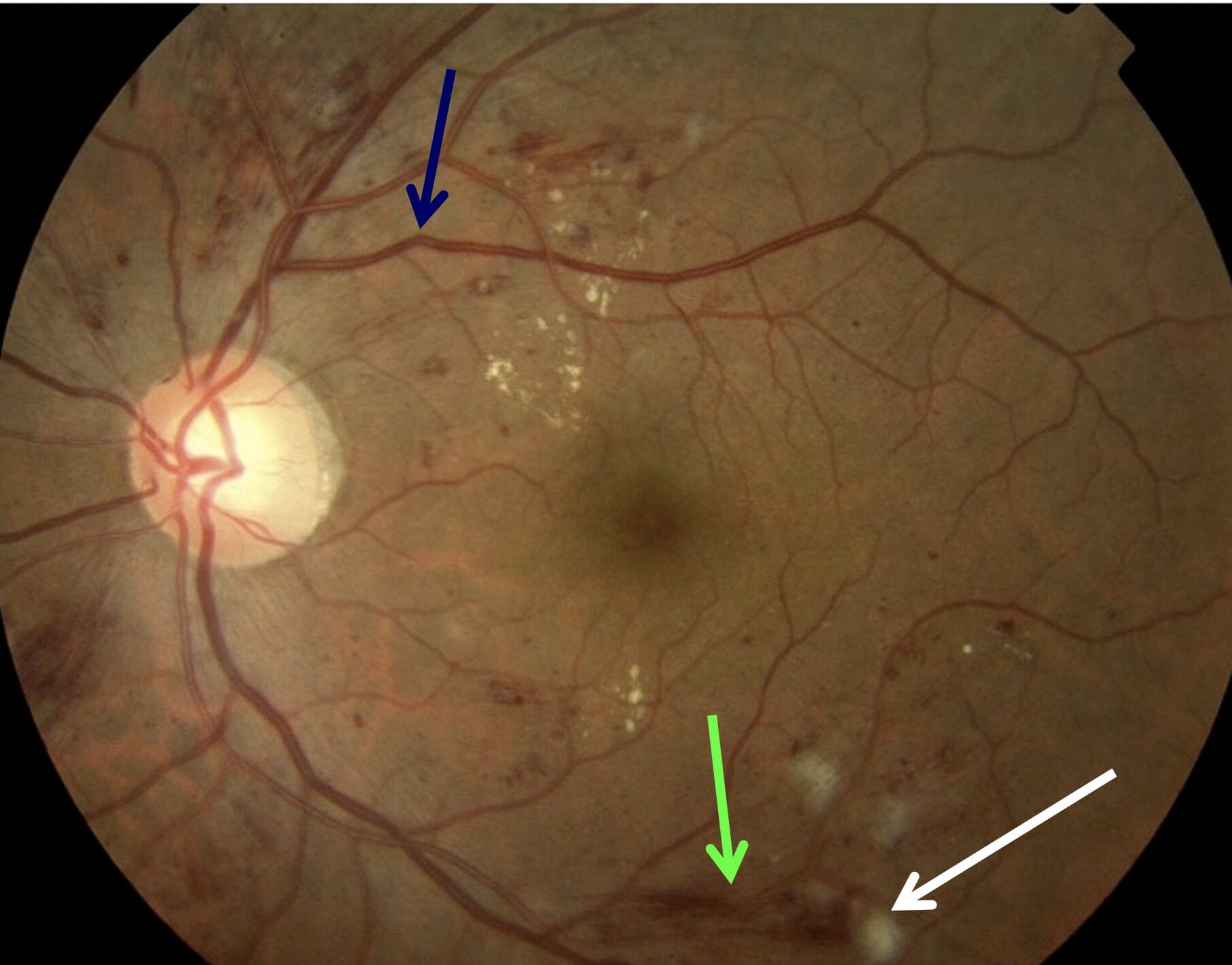Blue arrow: early venous beading; green arrow: flame haemorrhage; white arrow: cotton wool spot.