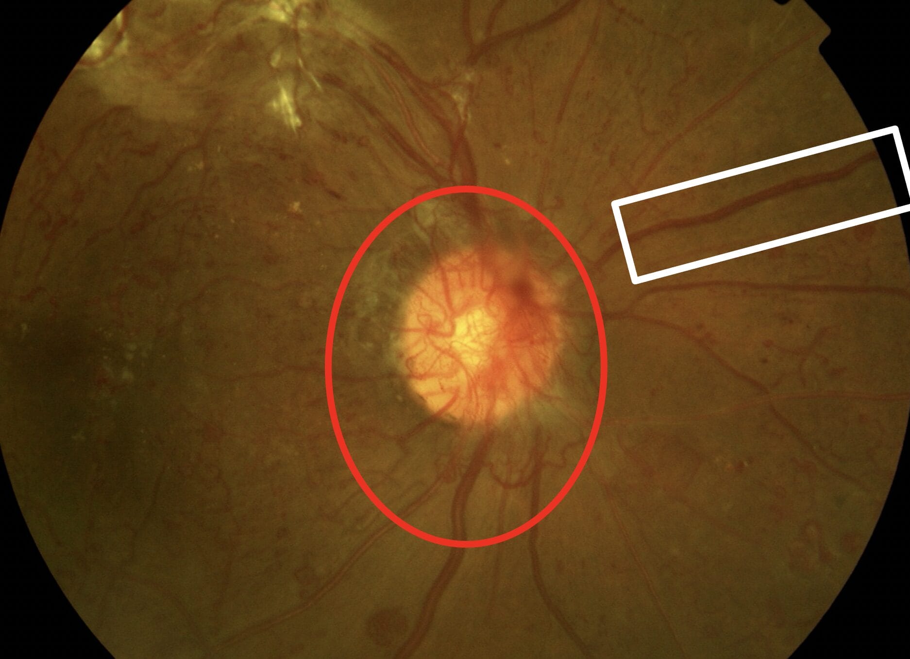 Figure 4. Red circle: optic disc new vessels; white rectangle: venous beading.
