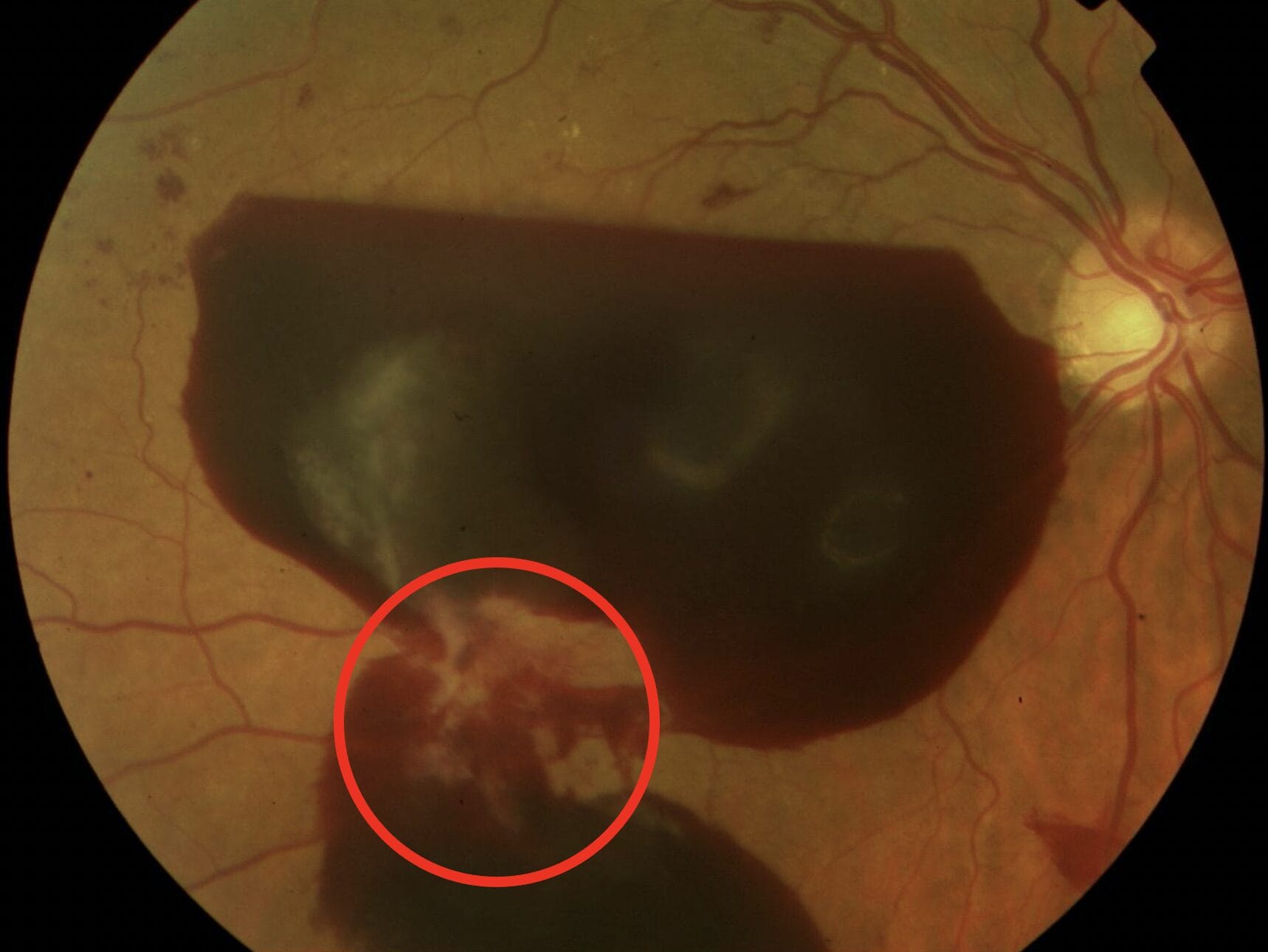 Figure 5. Retrohyaloid haemorrhage. Red circle: new vessels elsewhere with fibrosis.