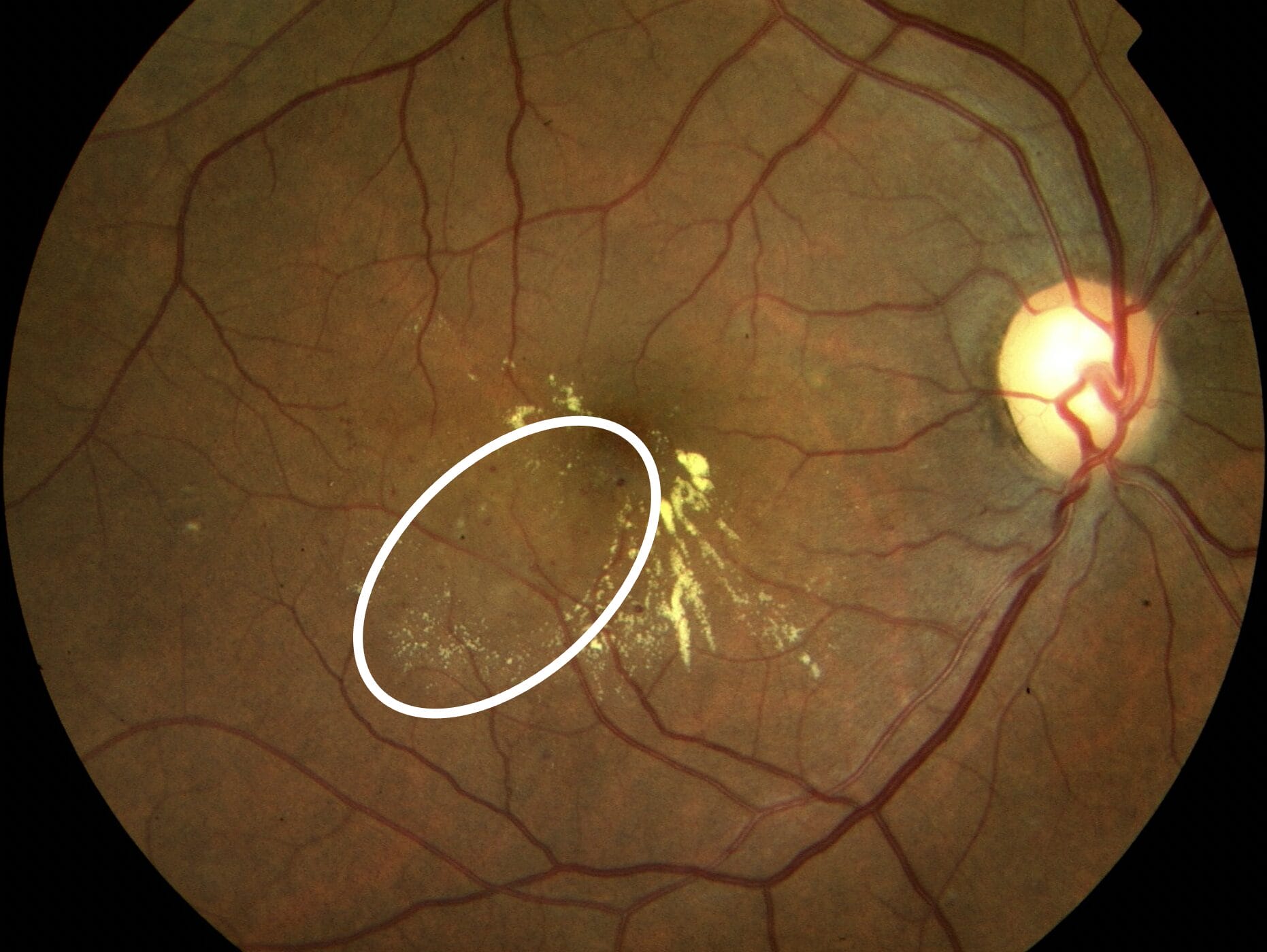 Figure 6. White eclipse: microaneurysms with hard exudates and retinal thickening.