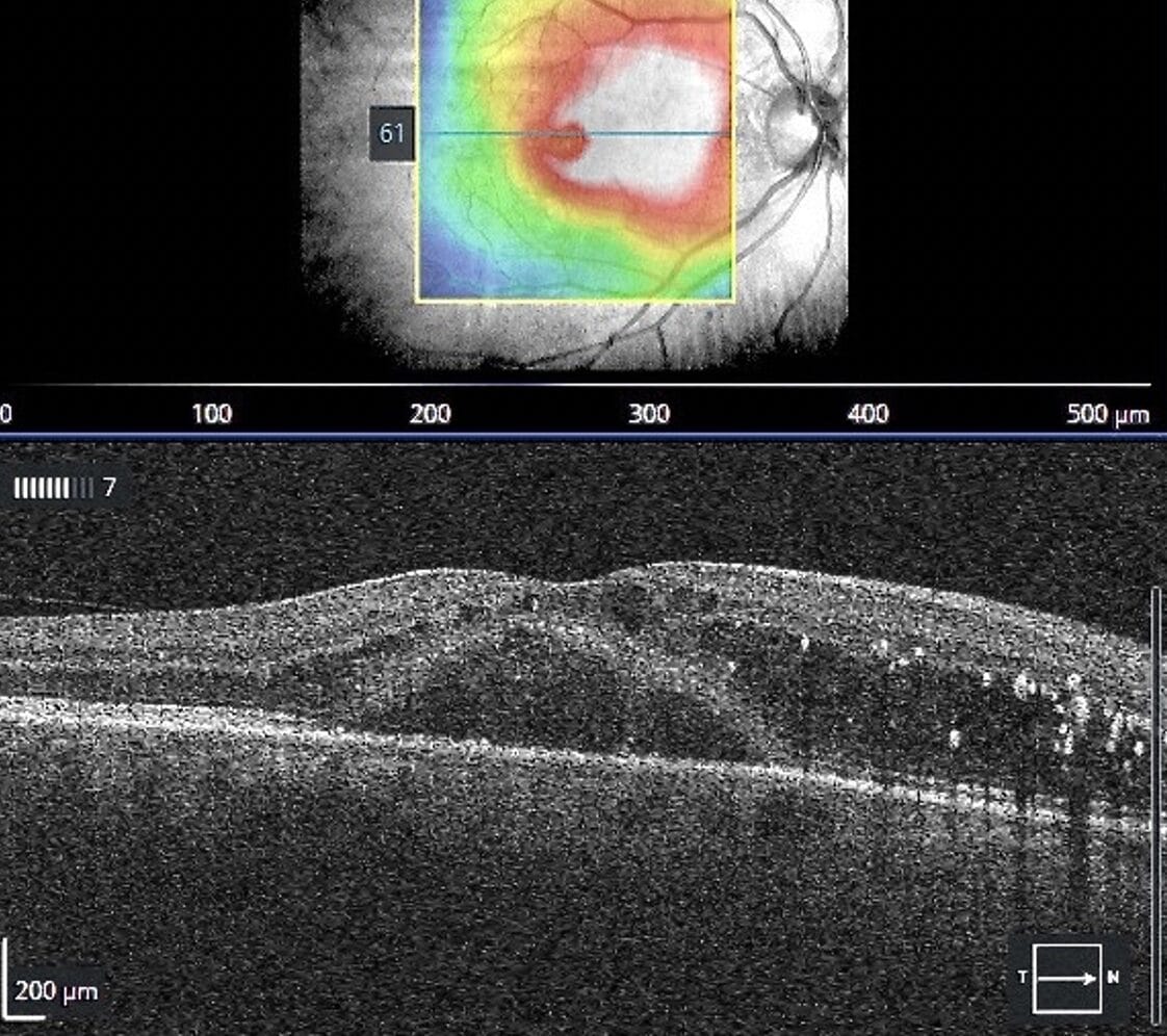 Figure 7. OCT of the macula showing centre involving macular oedema (CSMO).