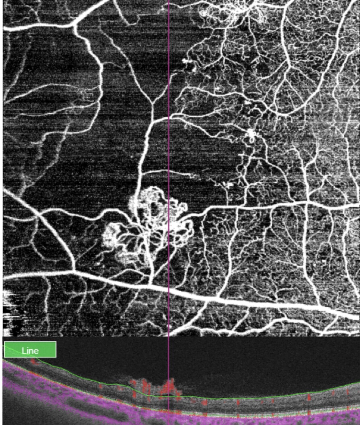 Figure 9. OCT and OCT-A of a patient with diabetes and severe PDR showing the anatomical location and blood flow of neovessels. By modifying the en face OCT-A slab and segmenting the vitreoretinal interface, the extra retinal neovascularisation can be easily visualised.
