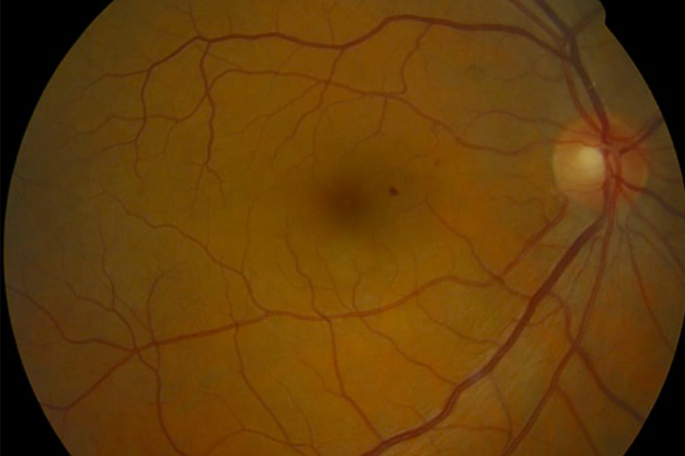 Figure 1. Mild NPDR with microaneurysm.