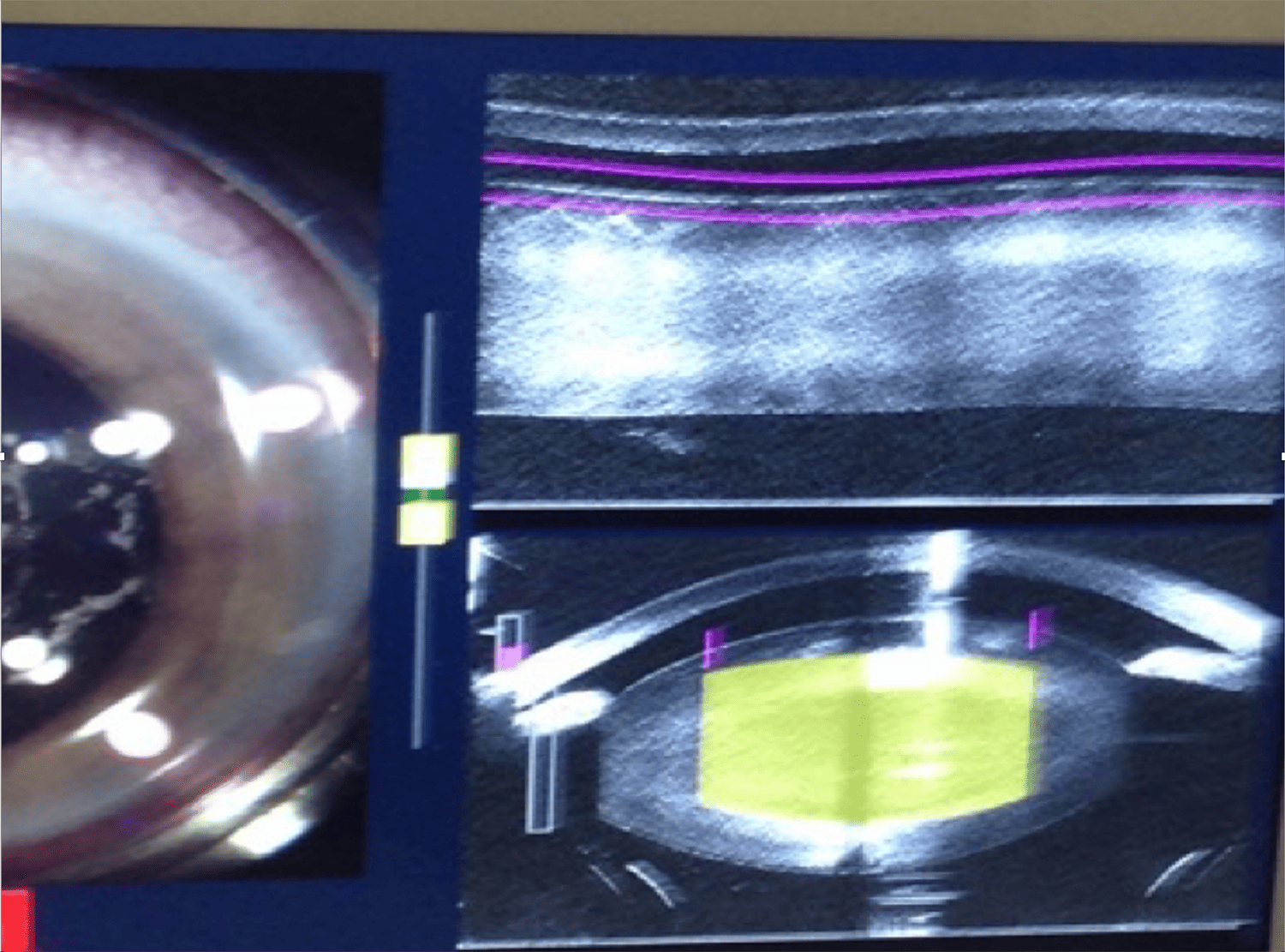 Figure 5. Shallow anterior chamber case.