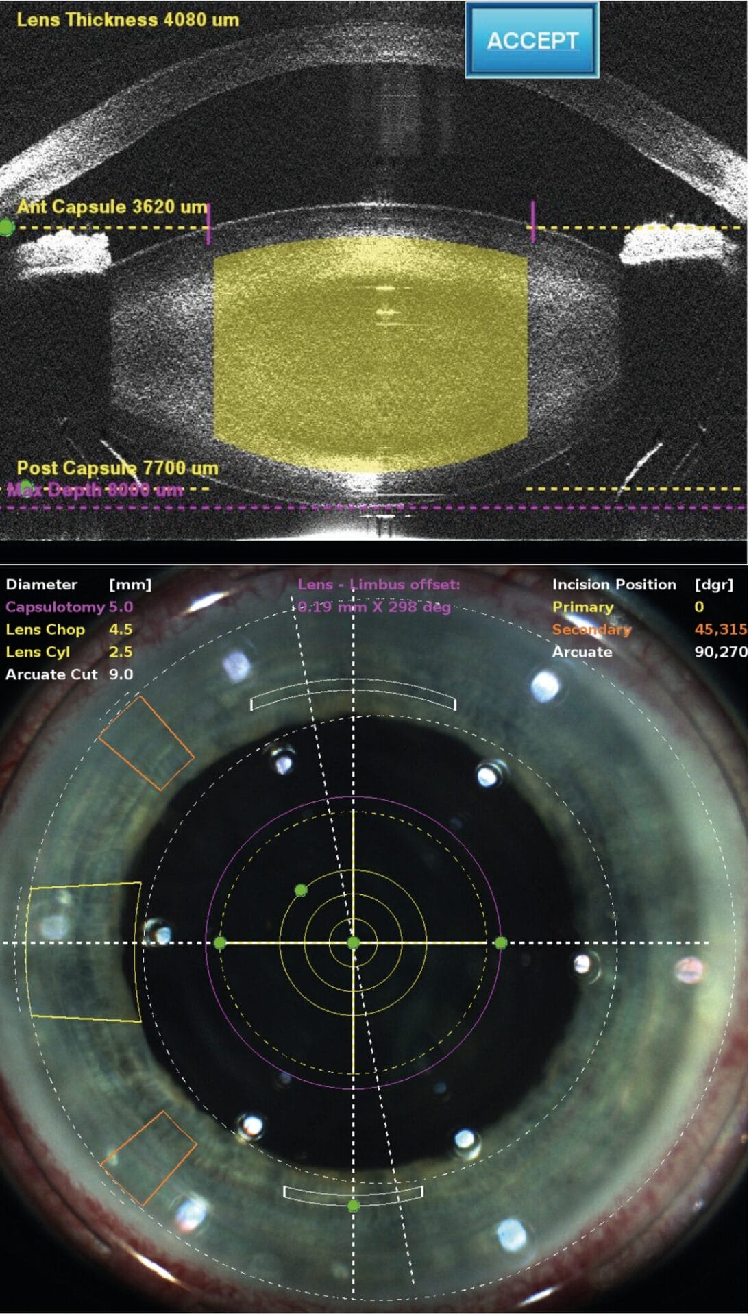 Figure 2. Image-guided capsulotomy, incisions, and lens division.